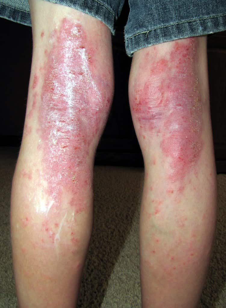 Eczema attack 