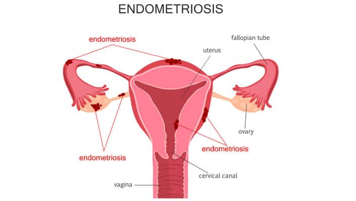 endometriosis