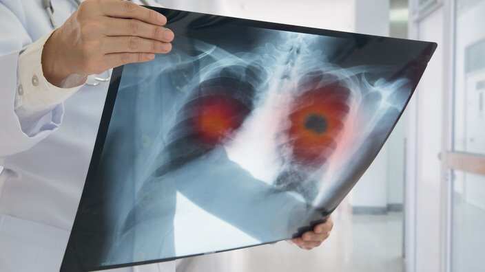 x-ray lung cancer