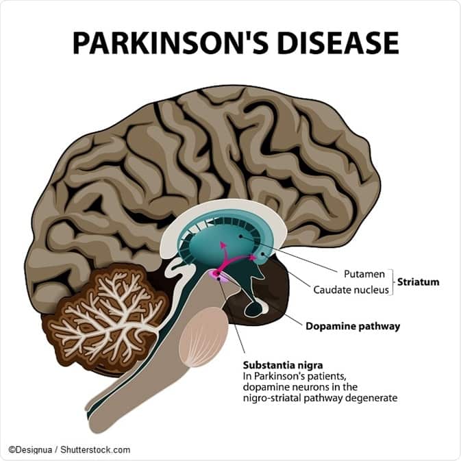 What is Parkinson  disease