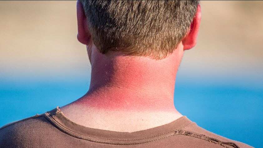 Man sun burnt