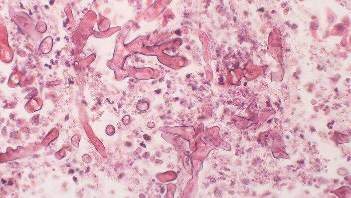 Zygomycosis/ mucormycosis under microscope