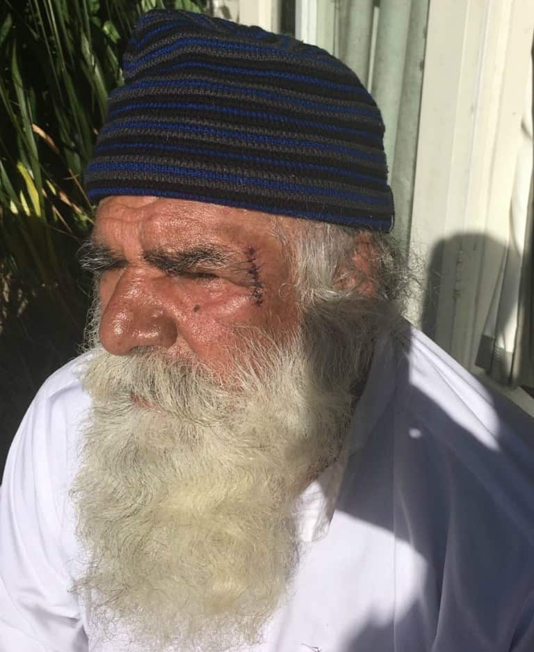 Narinder Singh with five stitches on the left side of his head