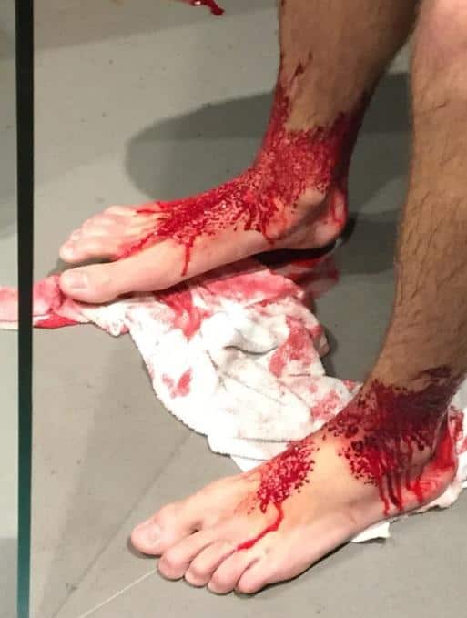 A supplied image obtained on August 6, 2017 of 16-year-old Sam Kanizay in a Melbourne Hospital (AAP)