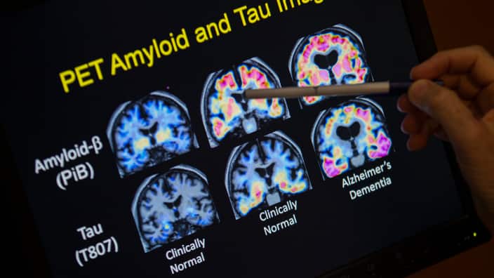 file photo, a doctor points to PET scan results that are part of a study on Alzheimer's disease at a hospital in Washington.