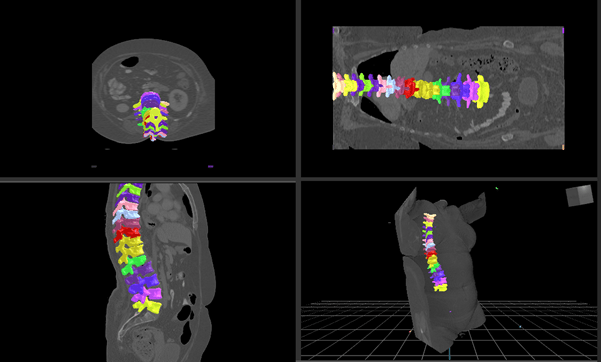 An example of the spinal segmentation software.