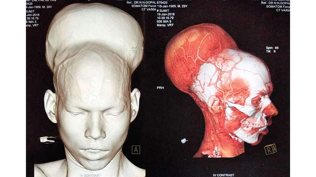 tumour