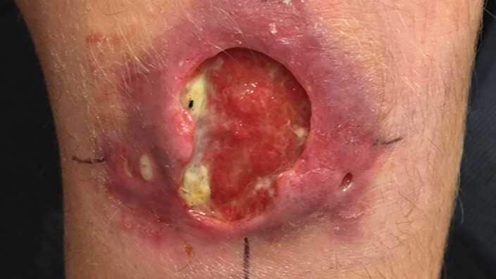 Buruli ulcer