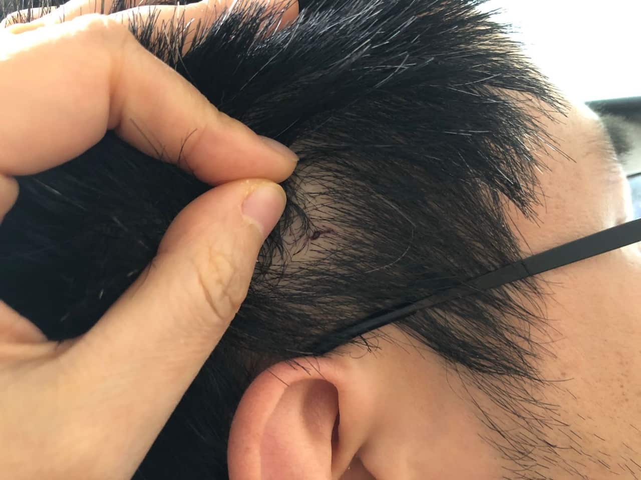 Francis was left with a wound on his head