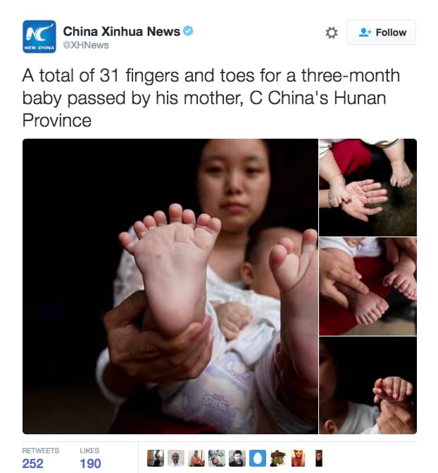 baby, 31 fingers, china