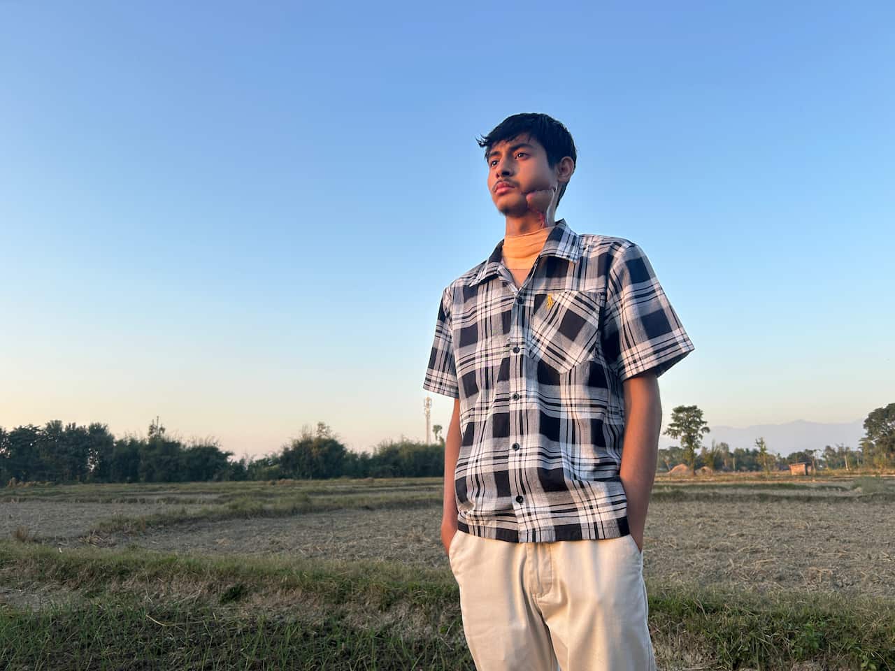 A young man stands in a field with his hands in his pockets. He has a large scar running through his left chek down to his neck. 