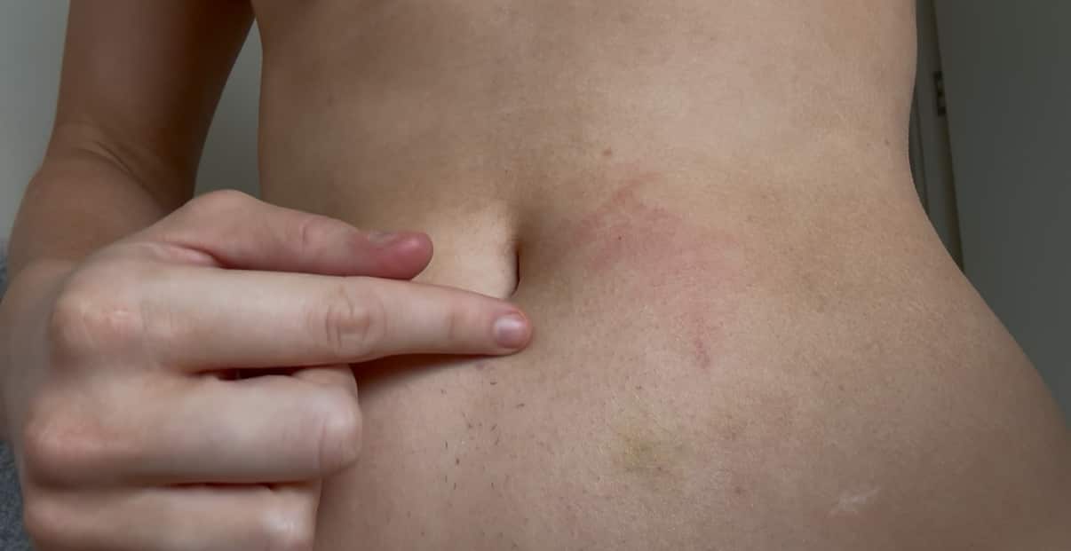 a closeup of a bruised stomach of a young woman
